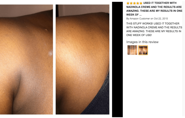 kojic acid soap before and after picture 3