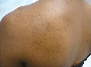 Why are medium to dark-skinned people more prone to getting dark spots?