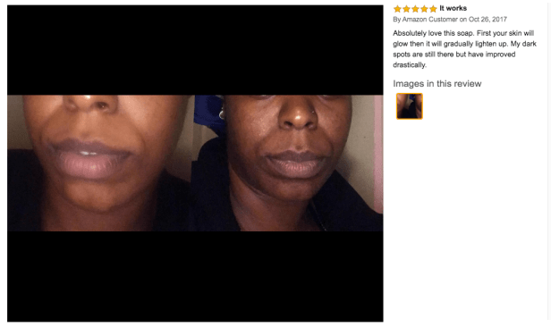 kojic acid soap before and after picture 1