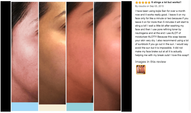 kojic acid soap before and after picture 5