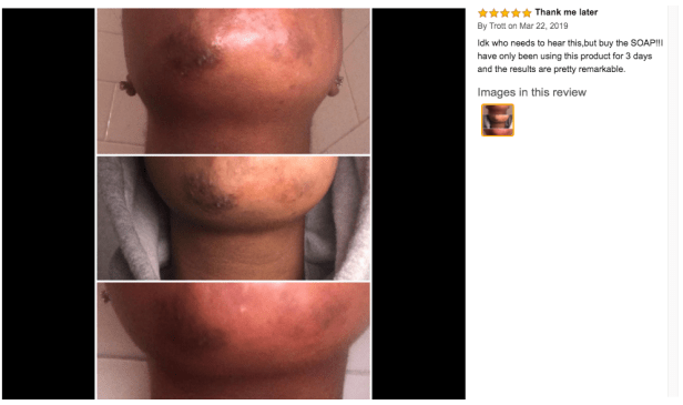 kojie san review before and after