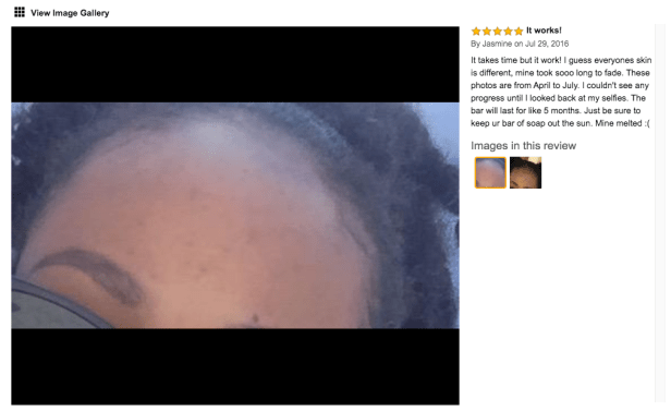 kojic acid soap for acne dark spots on dark skin after picture