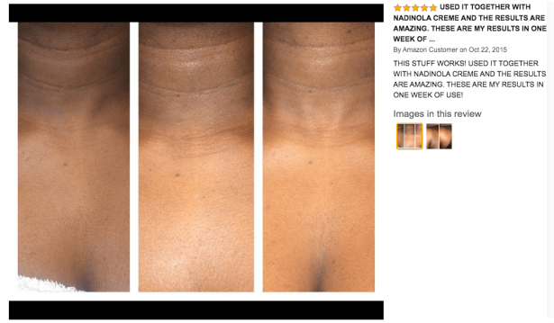 kojic acid soap before and after picture 3