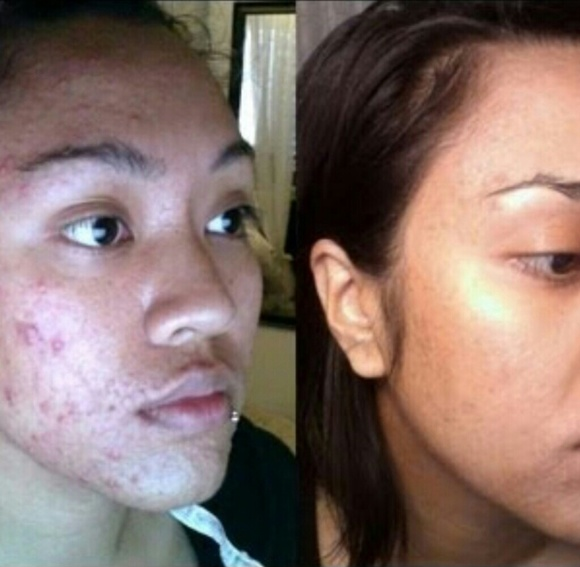 Kojic acid soap will not change your skin color