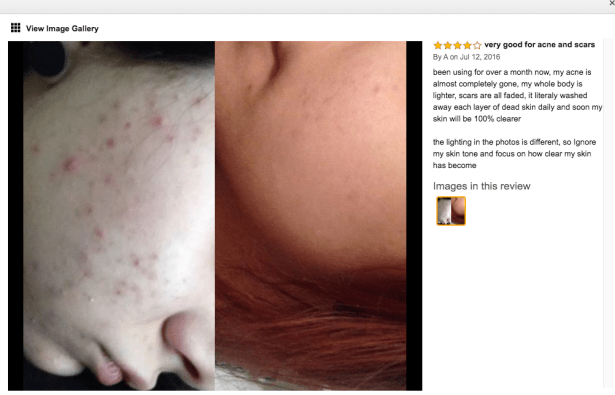 acne scars before and after picture