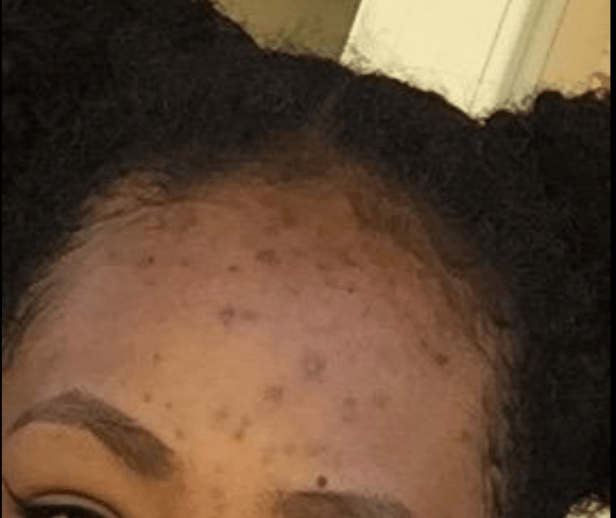 kojic acid soap for acne dark spots on dark skin before picture